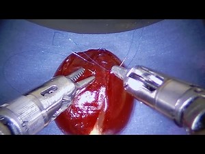 This surgical system can stitch a grape back together