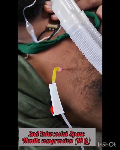 Emergency Needle Thoracocentesis 🩻💉🫧 #drkmc #pneumothorax #needlethoraco