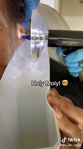 Ear Wax Removal: Unbelievable Amount of Wax Extracted!