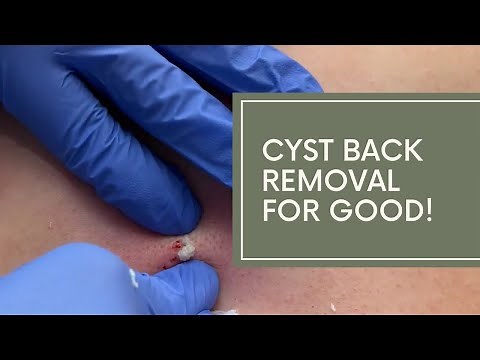 Back Cyst Removed For Good | DrDerm