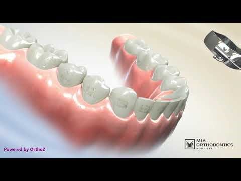 Braces Debonding: Removing Brackets and Adhesive at the End of Treatment