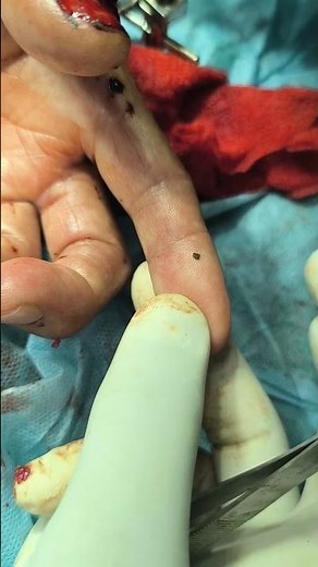 checking capillary refill time