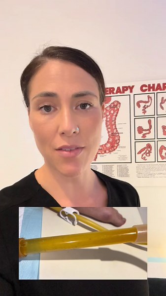 Day 5 Water Fast Results | Colon Hydrotherapy Session Revealed