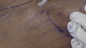 Laser Liposuction Requires Special Local Anesthesia