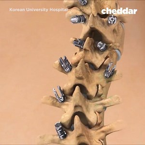 580K views · 251 reactions | This is a less-invasive spine surgery called MIS (Minimally Invasive Spinal Surgery.) | Cheddar Health | Facebook