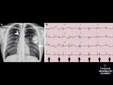 Twiddler’s Vs reel Syndromes 🫀: Emergencies Disorders Part II with under-recognized ECG syndromes