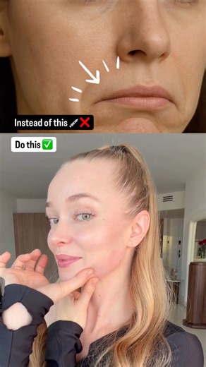 Before You Get Lip Injections, Watch This First #shorts