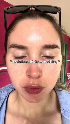 I want to be completely clear: My results have come from six years of using retinoids and three years of using azelaic acid. Most of my before and after pictures show the power of consistent, long terms use of retinoids. That being said, my skin really levelled up when I started using azelaic acid. I didn’t even start using it because I wanted more results, I was perfectly happy with my results. But I developed perioral dermatitis and azelaic acid is a treatment for that. My skin would certainly