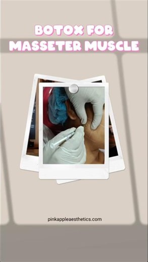 Masseter Botox in Bangalore | Jawline Slimming & Bruxism Treatment Explained #drpinkydeviayyappan