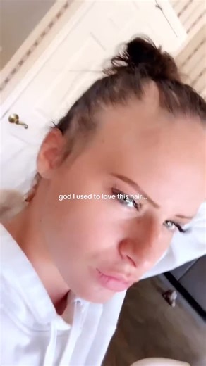 CHLOE BEAN on Instagram: "Something in the air and it’s called alopecia #hairloss #bald #alopecia"