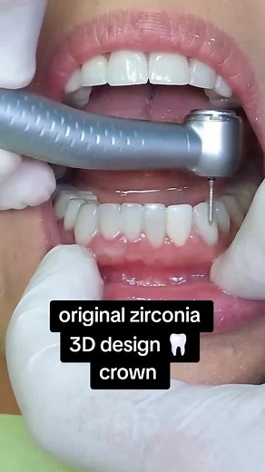 Natural Zirconia Crown: 3D Design Explained
