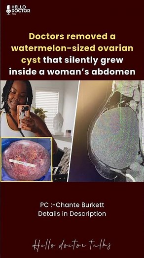Doctors removed a watermelon-sized ovarian cyst that silently grew inside a woman’s abdomen #cyst