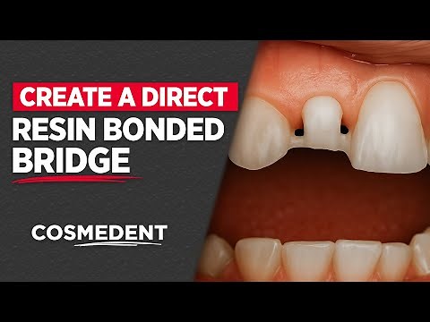 How to create a Direct Resin Bonded Bridge