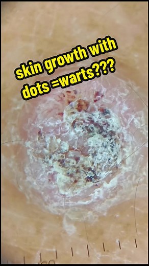 #wart seeds #plantar warts #warts #wart seeds explained #how to remove warts #how to get rid of plantar warts #get rid of warts #how to get rid of warts #inexpensive cure for warts #seed warts home remedies #painful warts #drdyoie