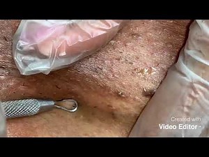 Extractions ( black head / ingrown hair removal )