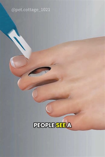 Hammer Toe Surgery 3D Animation #hammertoesurgery #hammertoesugery #hammertoes #hammertoefusion #hammertoerepair #footsurgery #toesurgery #medical3danimation #3dmedicalanimation