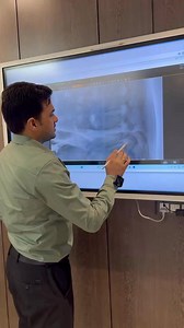 Treating an Old Pars Fracture in the Back #trendingreels | Dr. Harish Grover Chiropractor