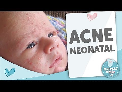 NEONATAL ACNE, LEARN EVERYTHING ABOUT IT - MOTHER'S TIPS