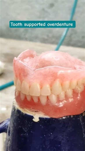 Tooth supported overdenture