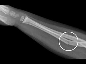 Green stick fracture