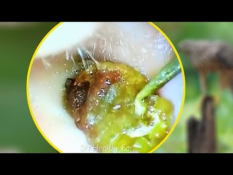 真珠腫性中耳炎の除去 P318