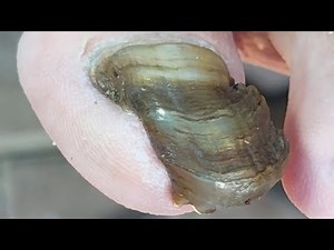 Long Black Toenails With A Lot Of Black Mud That Has Not Been Cleaned【Podiatry Clinic】