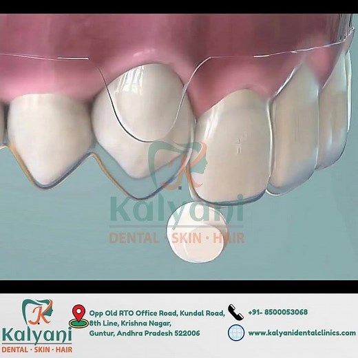 "How Aligners Bring Down a High Tooth to the Normal Line | Clear Aligner Tooth Movement Explained!"