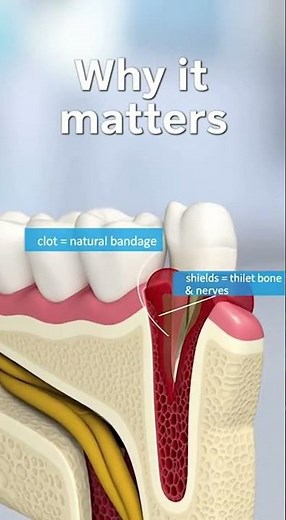 🦷 Why the Blood Clot After a Tooth Extraction Is So Important