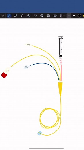 Understanding TD Swan: A Guide to Hemodynamics in Critical Care