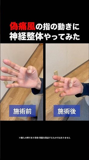 When I tried nerve manipulation for the difficulty in moving my fingers due to pseudogout...