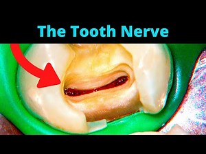Tooth Cavity - Partial Pulpotomy Procedure  • Video • MEDtube.net