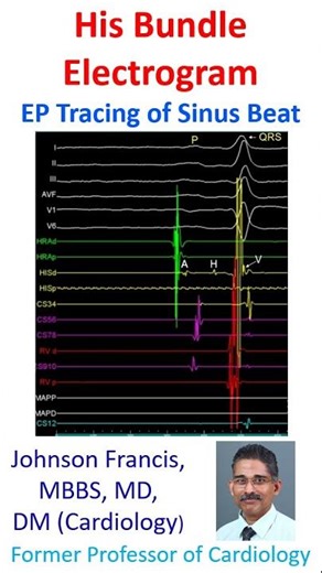 His Bundle electrogram: EP Tracing of Sinus Beat