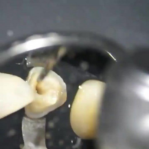 19K views · 395 reactions | Post & Core Buildup #Dentistry #LearningTips #BitesnBraces @Bites.Braces | Bites & Braces Dental | Facebook