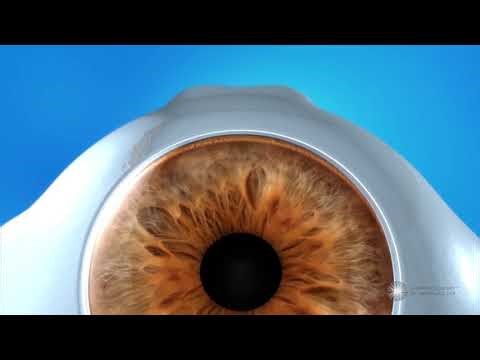 What is a trabecular bypass stent?