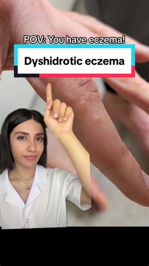 Understanding Dyshidrotic Eczema: Causes, Symptoms, and Treatments