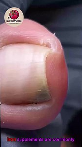 88K views · 548 reactions | Smart Ways to Help People with Curved Nails Care for Your Feet Naturally #EverydayCare #SafeSteps #FootSupport #SeniorHealth | Bye | Facebook