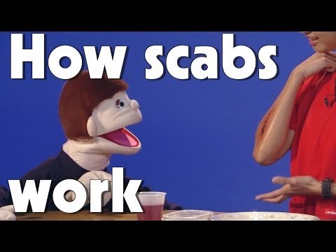 How Scabs Work | Kids Health | The Friday Zone | WTIU | PBS