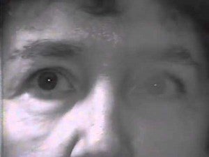 Dissociated Nystagmus