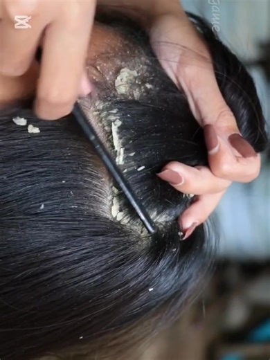 23K views · 165 reactions | Scalp care is essential for dandruff-free days  | The Flake Doctor | Facebook