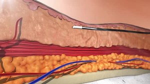 3d animation of hyaluronic acid injection with needle. Section of skin and epidermis layers