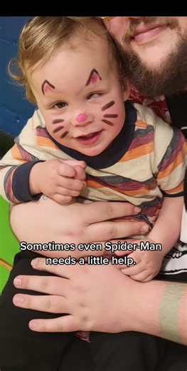 Microphthalmia is an eye condition that happens before birth. In this condition, one or both eyeballs are abnormally small. In some individuals, the eyeball may appear to be completely missing; however, even in these cases some remaining eye tissue is generally present. In this case it was only one small eye and as a general rule because of rapid grown in children it is best to be fit with the childs growth to stimulate bone growth and preserve facial symmetry. He is also a recipient of the fun