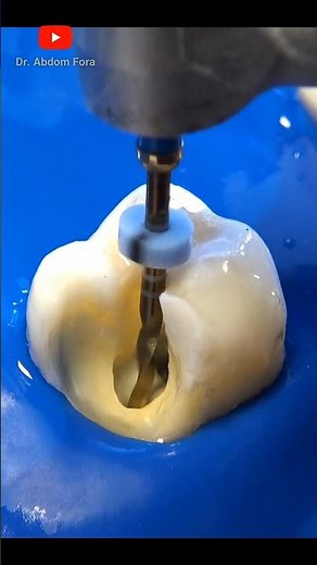 How is a root canal performed?