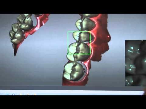 The CS 3600 intraoral scanner in action
