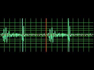 Ventricular Septal Defect- normal speed
