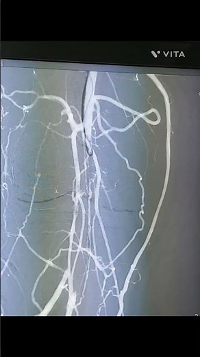 Popliteal Artery Stenting –#PoplitealArteryStenting#PoplitealArtery#PeripheralArteryDisease
