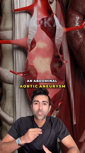 Kunal Sood, MD on Instagram: "An abdominal aortic aneurysm is a silent ballooning of the body’s main artery that can rupture without warning. It’s often linked to age, smoking, and high blood pressure, and is best detected through ultrasound screening before it grows too large. Early detection and elective repair significantly reduce the risk of fatal rupture. Did you know this? VC: @voka.io Follow @doctorsoood to improve your health IQ and for similar content. #abdominalaneurysm #aorticaneurysm
