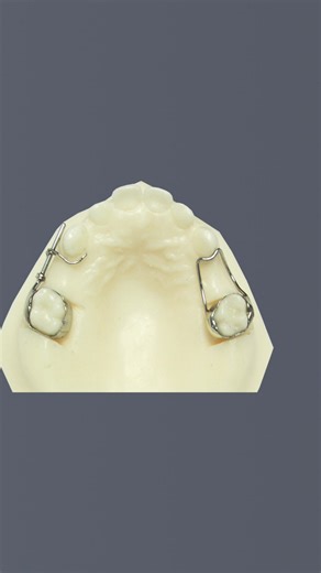 Space regainer / maintainer. A fixed appliance used in space management cases. If anyone wants a second opinion on appliance design before fabrication, we review cases in advance. 👉 [https://www.polusa.org/case-review/](https://www.polusa.org/case-review/) | Precision Orthodontic Laboratory