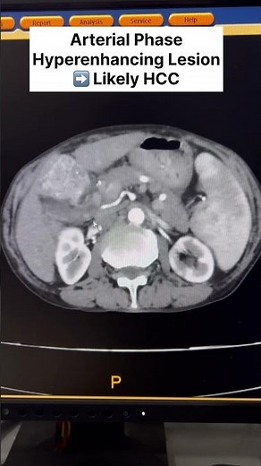 Triple Phase CT HCC Case You Can’t Miss! 😱 #shorts