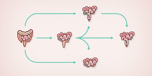 Patient Learning: Surgical treatment for ulcerative colitis - TVASurg - The Toronto Video Atlas of Surgery