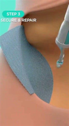 Laparoscopic Hernia Repair: The Mesh Technique #shorts #surgical